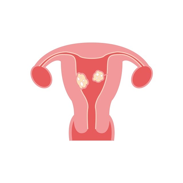 Fibroids photo